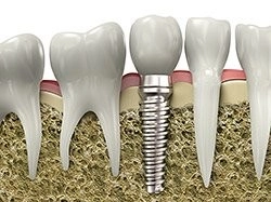 dental implant restorations tucker