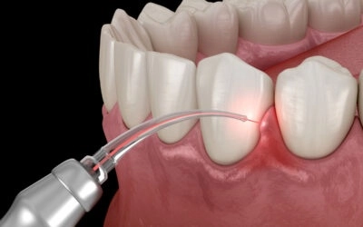 Laser Dentistry in Atlanta: How Advanced Technology Minimizes Pain and Drilling at Rose Dental
