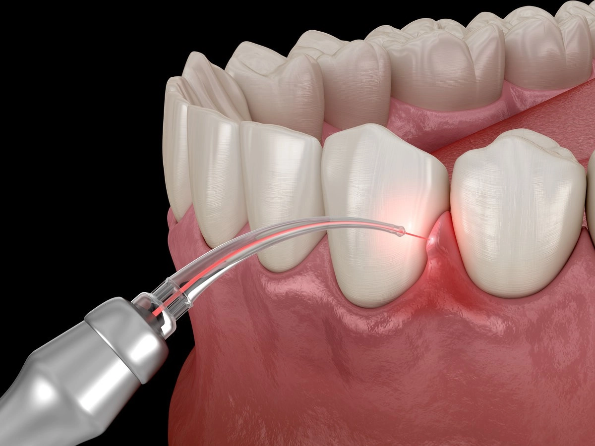 Gum correction surgery with laser. Dental 3D illustration Gum correction surgery with laser. Dental 3D illustration