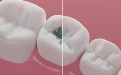 What You Need to Know Before and After Dental Amalgam Filling Removal