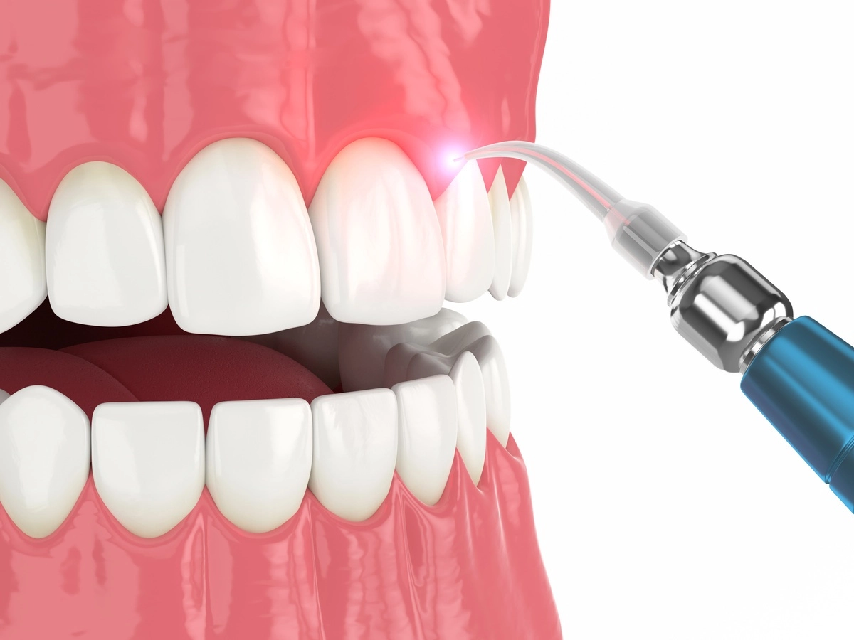 3d render of dental diode laser used to treat gums 3d render of dental diode laser used to treat gums