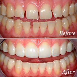 dental bonding near atlanta