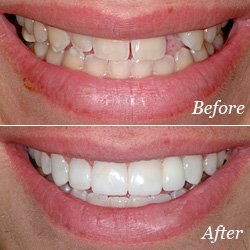 dental bridges near atlanta