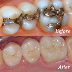 dental crowns  near atlanta