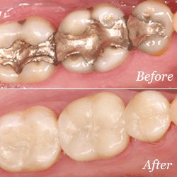 dental fillings tucker ga