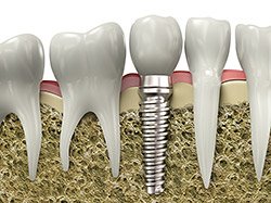 dental implant restorations tucker