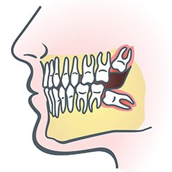 wisdom teeth removal
