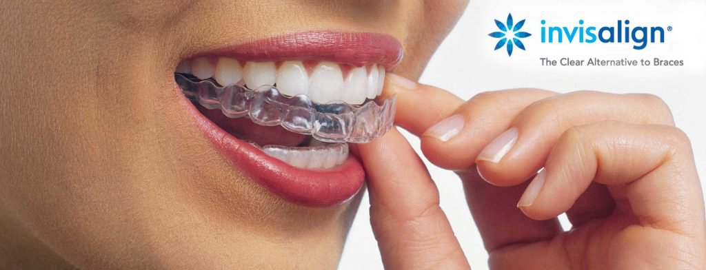 invisalign tucker ga