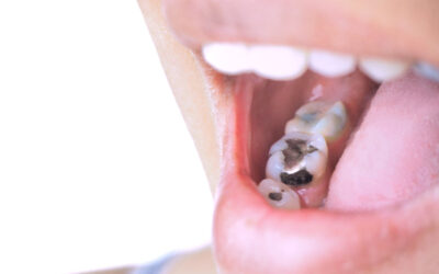 Mercury-Free Dentistry: What You Need to Know About Safe Amalgam Removal