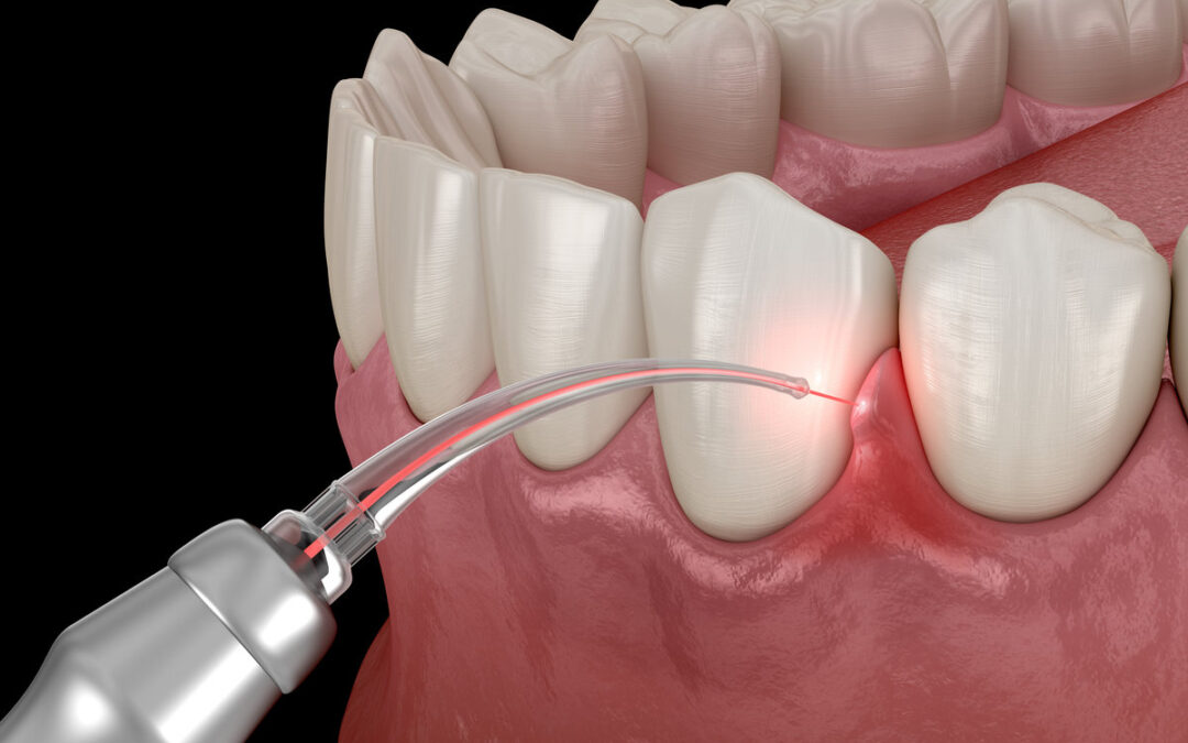 Laser Dentistry in Atlanta: How Advanced Technology Minimizes Pain and Drilling at Rose Dental