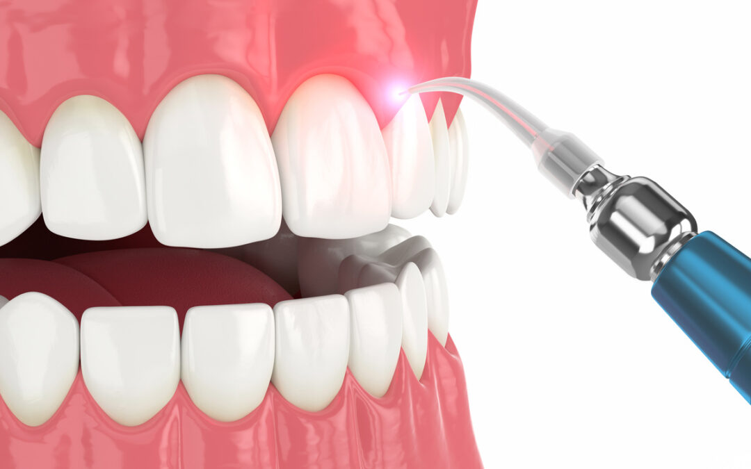 Laser Dentistry: How We Eliminate Drilling and Anesthesia for Fillings