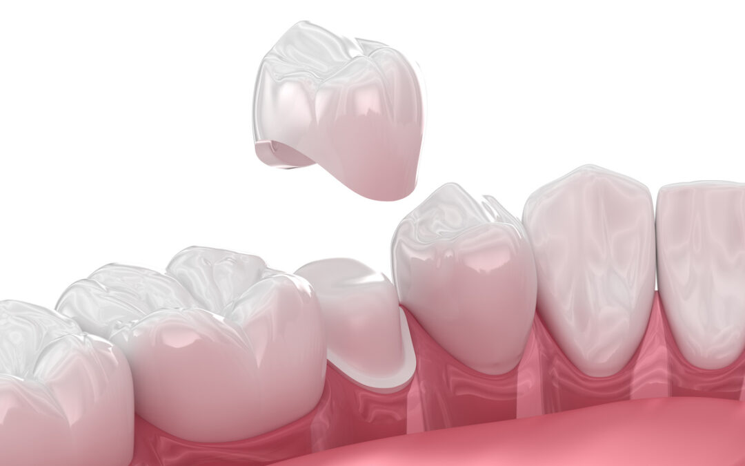 Are Zirconia Implants the Biocompatible Alternative to Titanium?