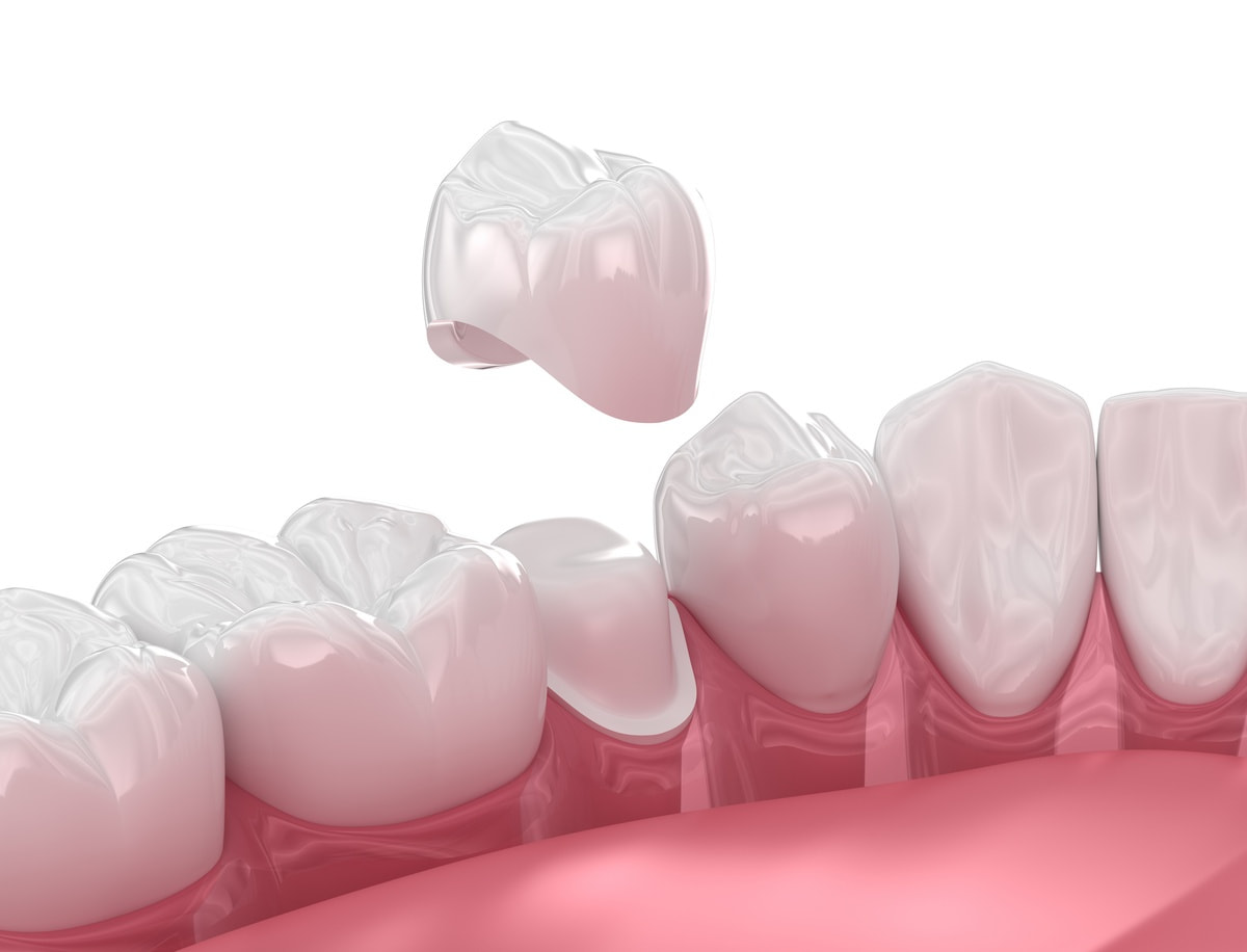 Dental crown placement over tooth. 3D illustration Dental crown placement over tooth. 3D illustration