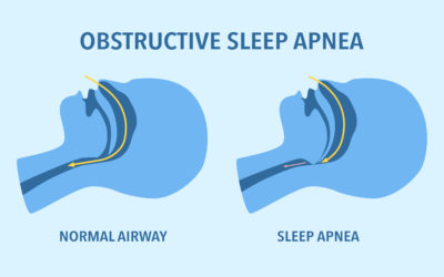 Sleep Apnea Solutions: How Airway-Focused Dentistry Can Transform Your Life