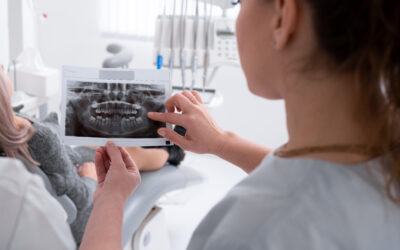 How Cavitations Form and Why Holistic Dentists Take Them Seriously