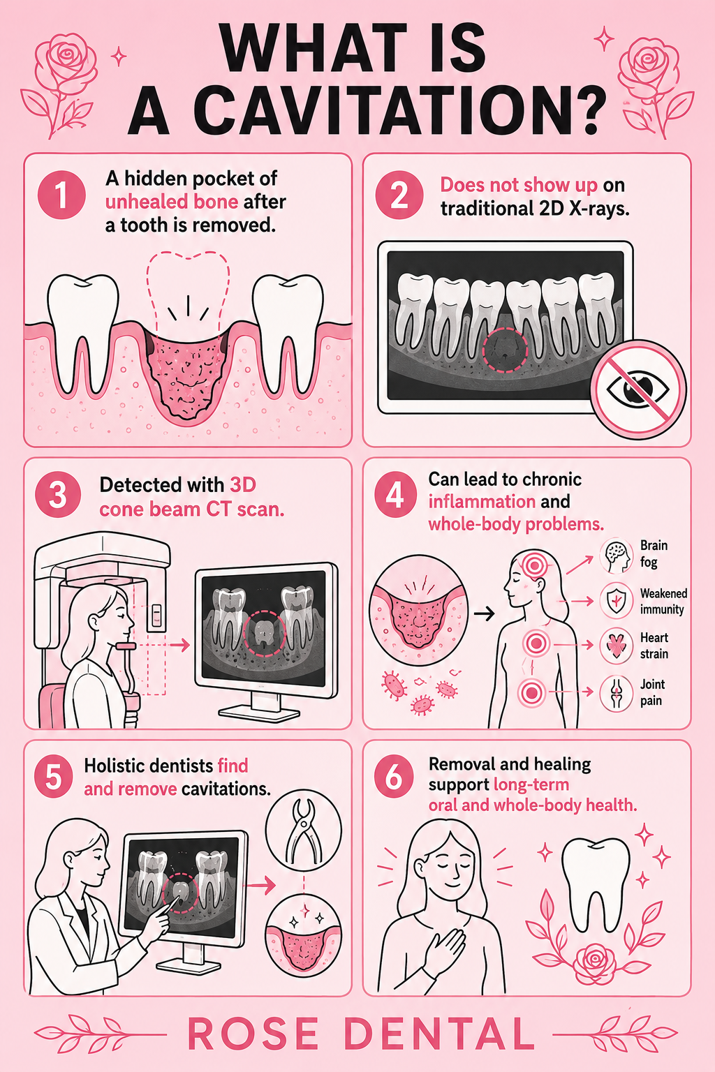 Infographic explaining how cavitations form and why holistic dentists take them seriously – Rose Dental